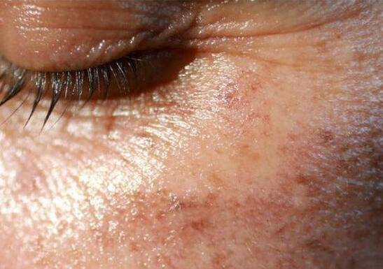 Crow&#39;s Feet Reference