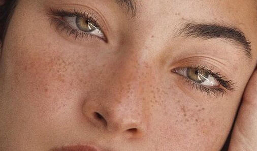 Freckles Reference